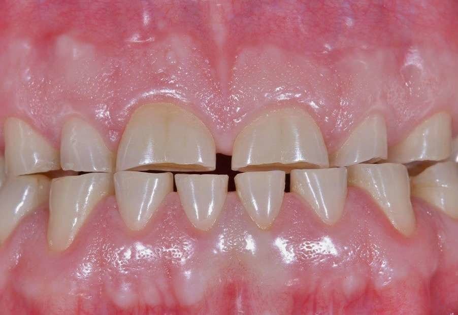 attrition causes worn teeth