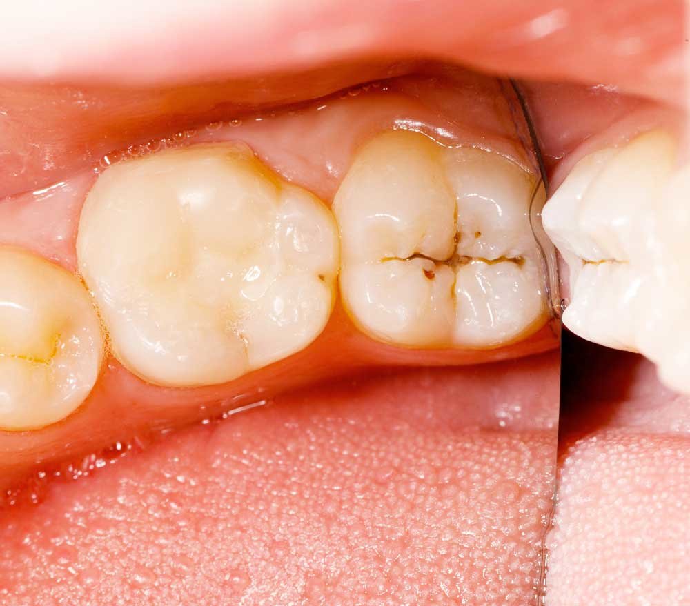 Laser dentistry treats cavity