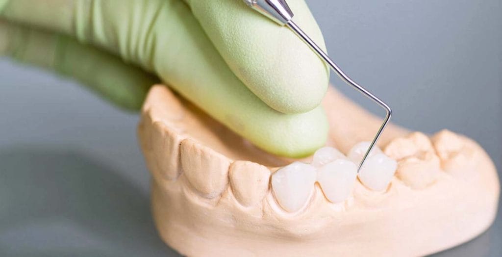 Dental Bridge