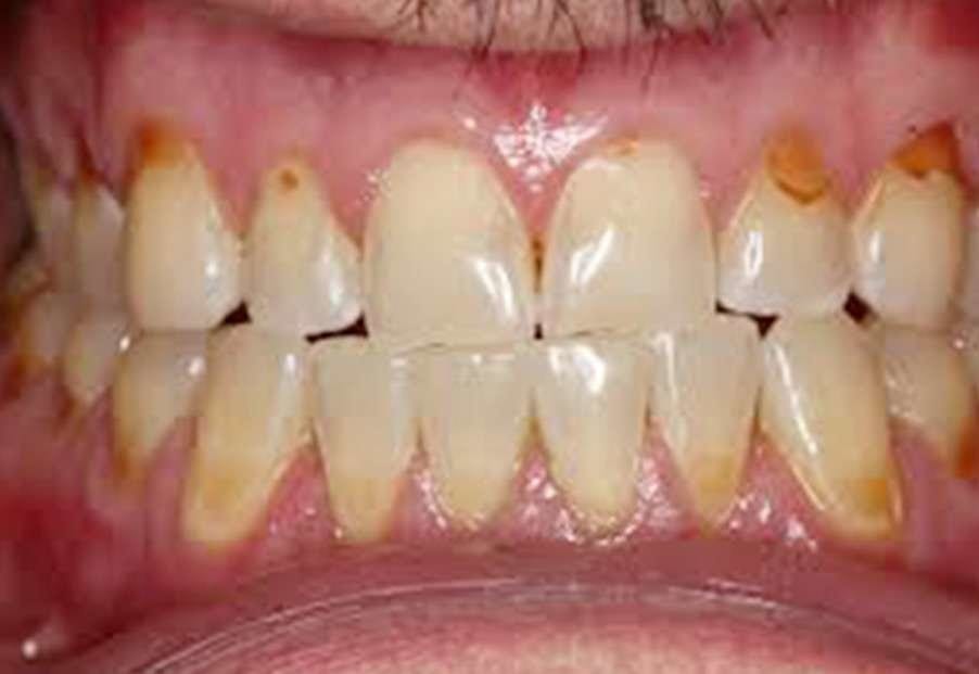 erosion causes worn teeth