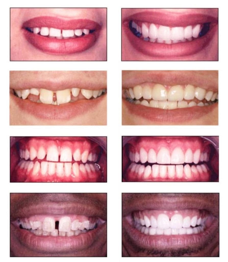 Gaps Spaces Between Teeth Dental Solutions Smile Concepts