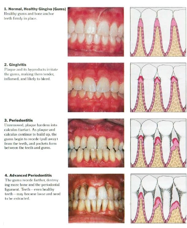 gum disease 4 stages