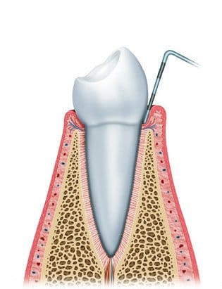 gum disease diagram4