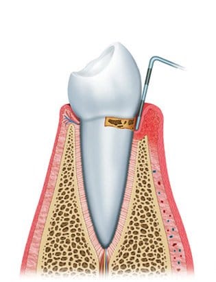 gum disease diagram3