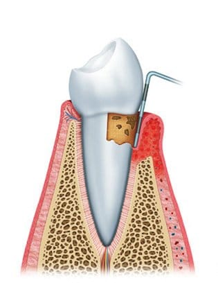 gum disease diagram2