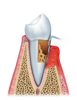 gum disease diagram