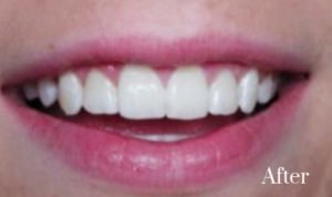 gummy smile treatment 2