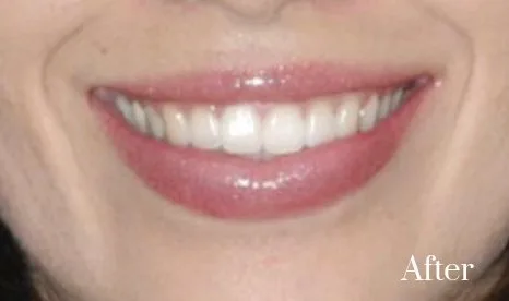 gummy smile treatment