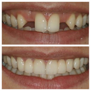 single teeth missing before and after 4