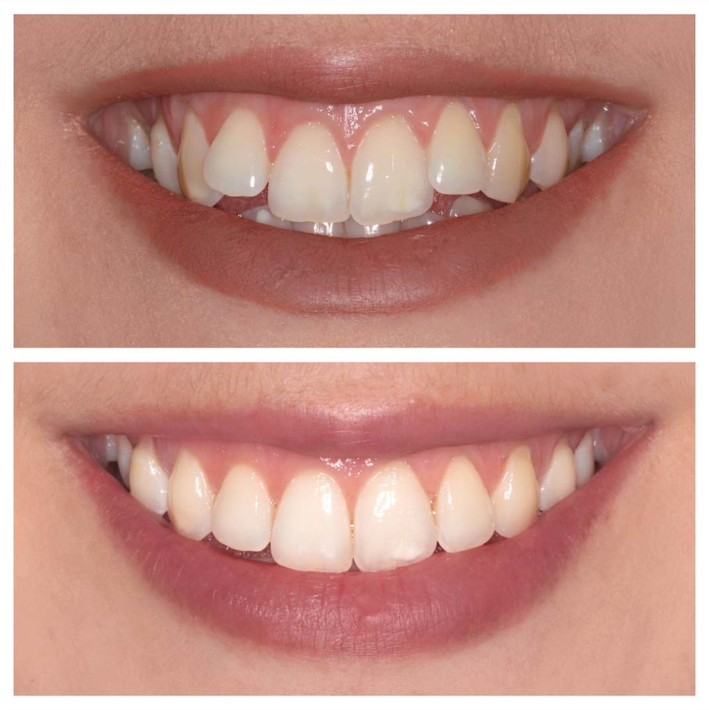 misaligned teeth orthodontics