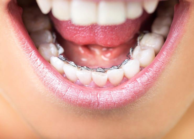 lingual braces1