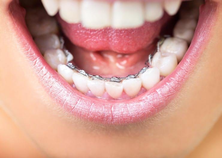 lingual braces1