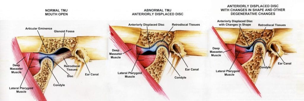 tmj pain and headaches