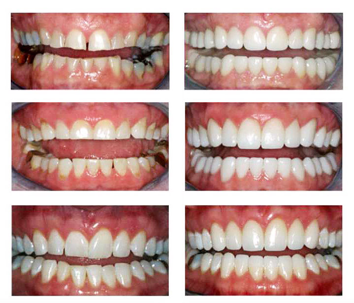 Worn Teeth, Rejuvenation with Porcelain Veneers | Smile ...
