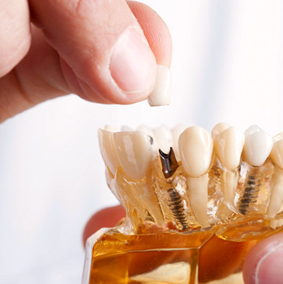 Process of Dental Implants