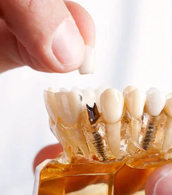 Process of Dental Implants