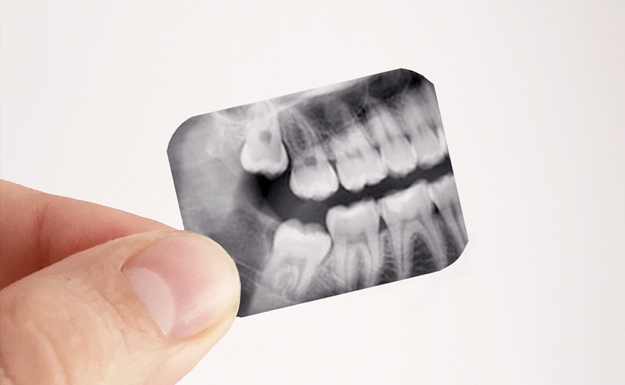 Wisdom teeth removal Cost Old Page