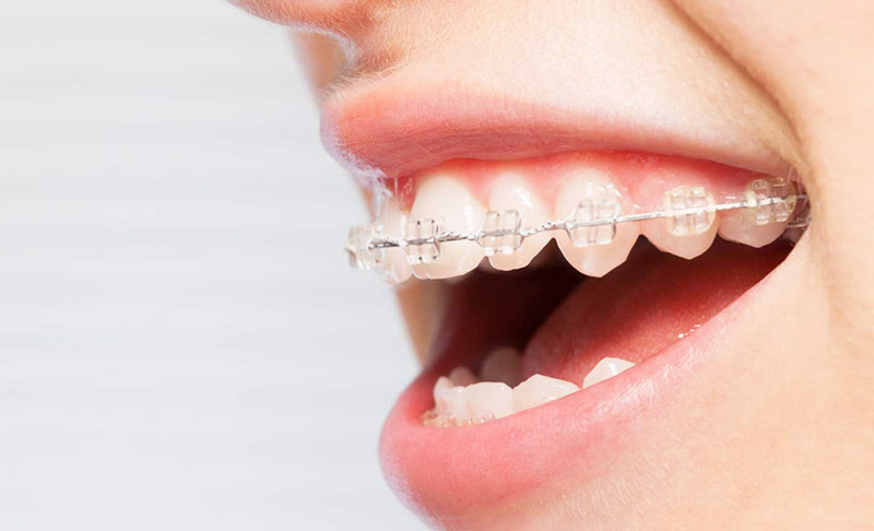 Ceramic braces Cost