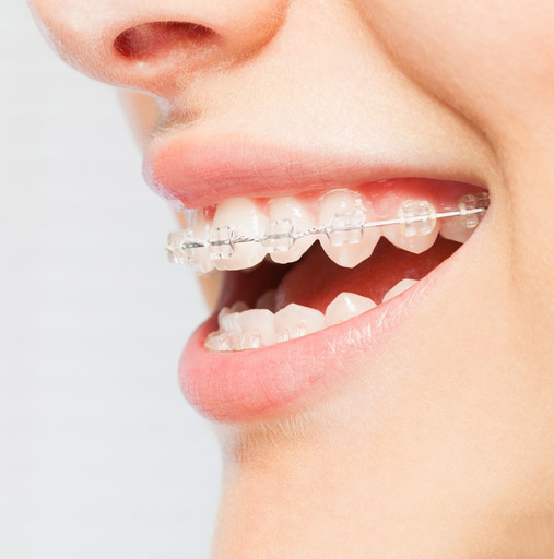 affordable clear braces cost