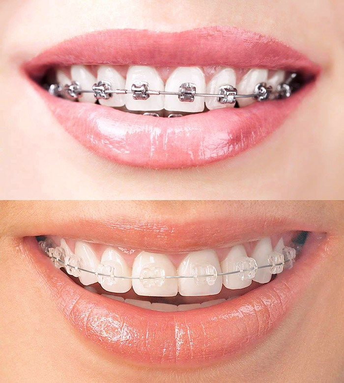 clear braces cost vs metal braces cost