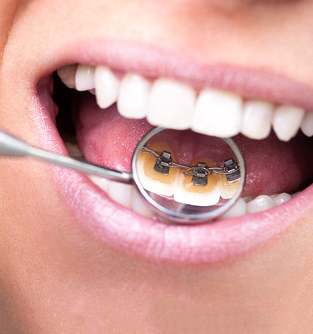 Lingual Braces Cost