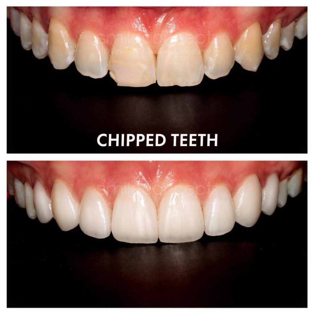 Chipped Teeth