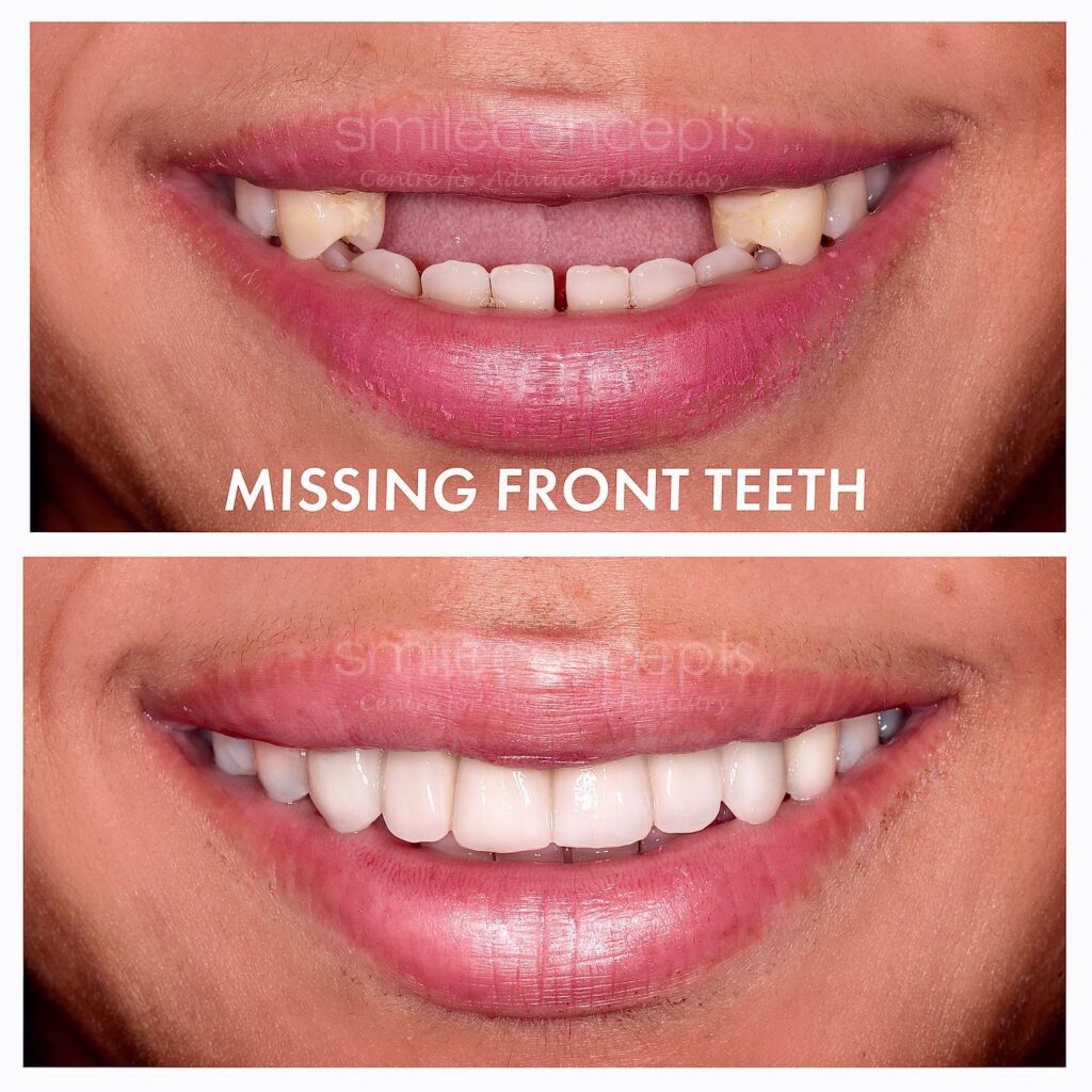 missing front teeth