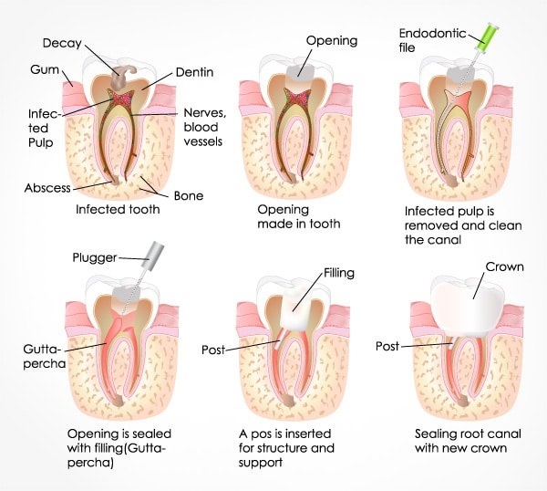 Root Canal Treatment Sydney