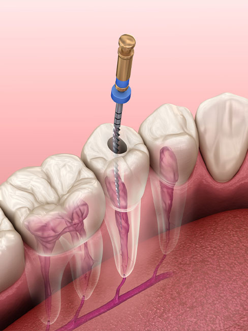 Root canal treatment procedure