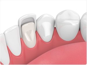 what are porcelain veneers