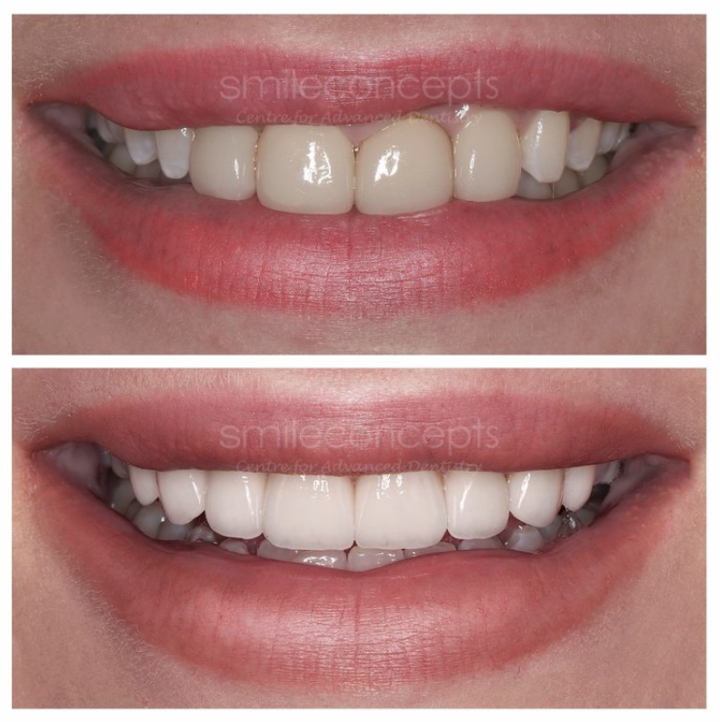 porcelain veneers before and after