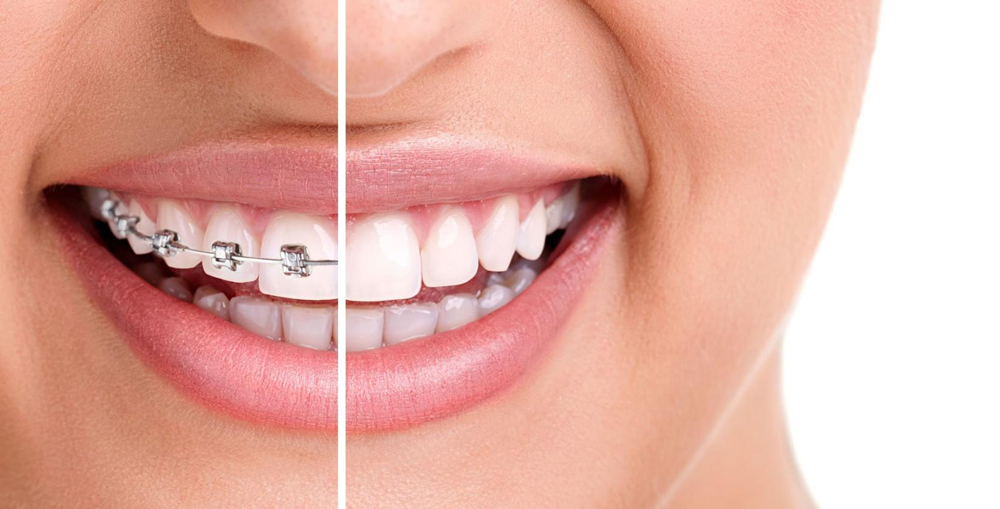 Truth Revealed: Braces vs. Invisalign - We’ll Find Your Match