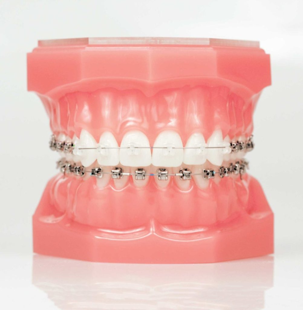 Truth Revealed: Braces vs. Invisalign - We’ll Find Your Match