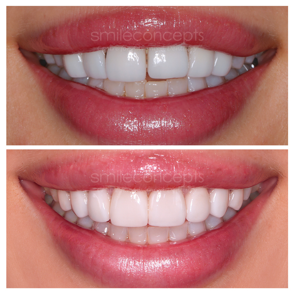 porcelain veneers makeover preparation stage