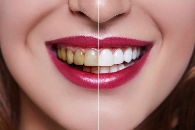 will porcelain veneers stain