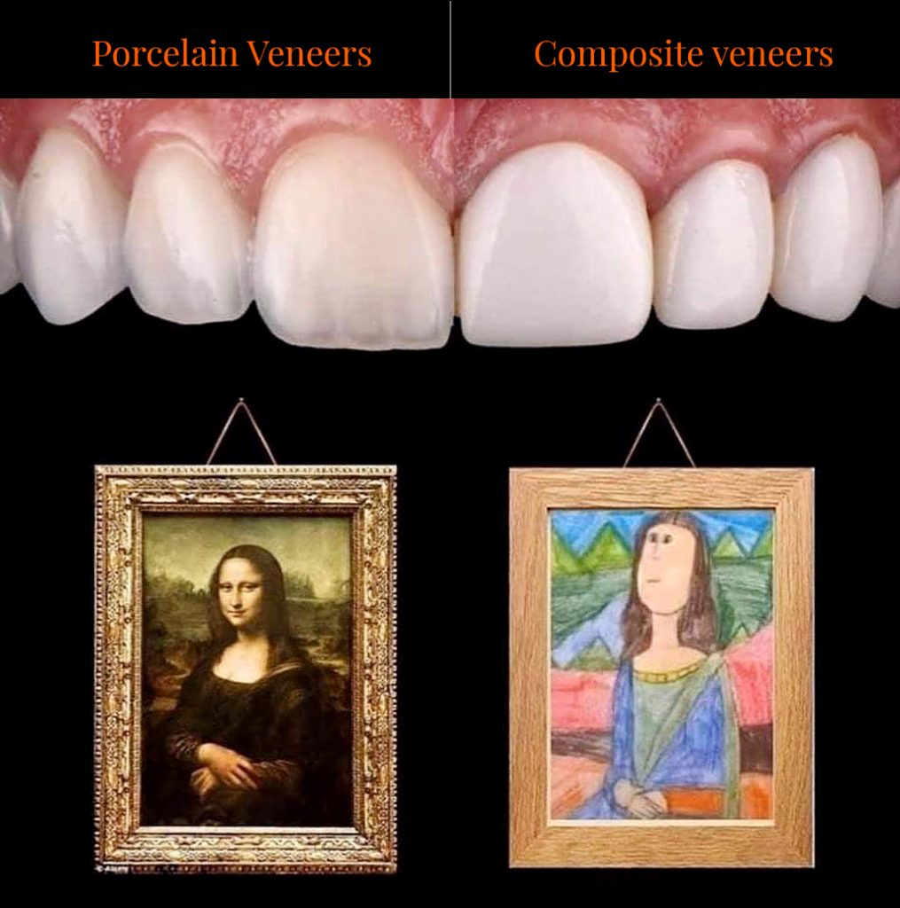 Porcelain-veneers-and-composite-veneers