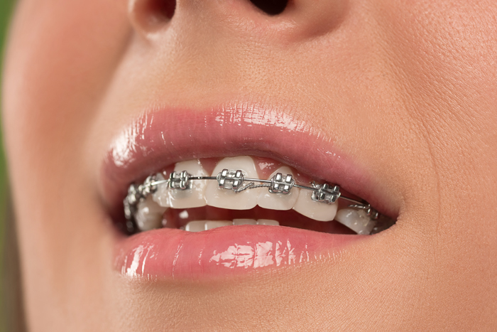 How Much Do Braces Cost In Australia? Dental Braces: Options, Procedures, and Costs