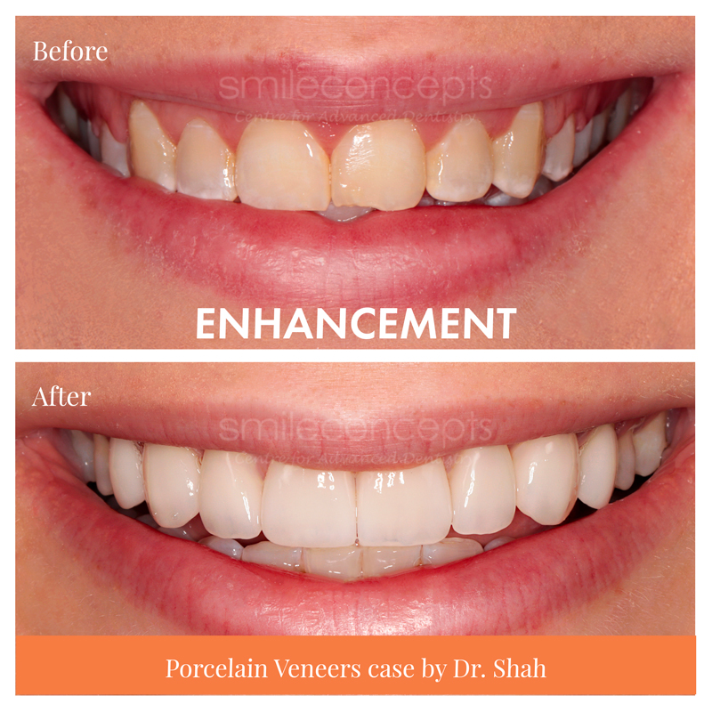 veneers