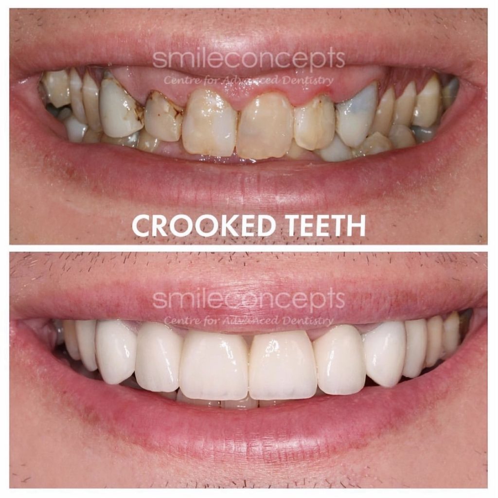 teeth straightening with Smile Concepts Porcelain veneers