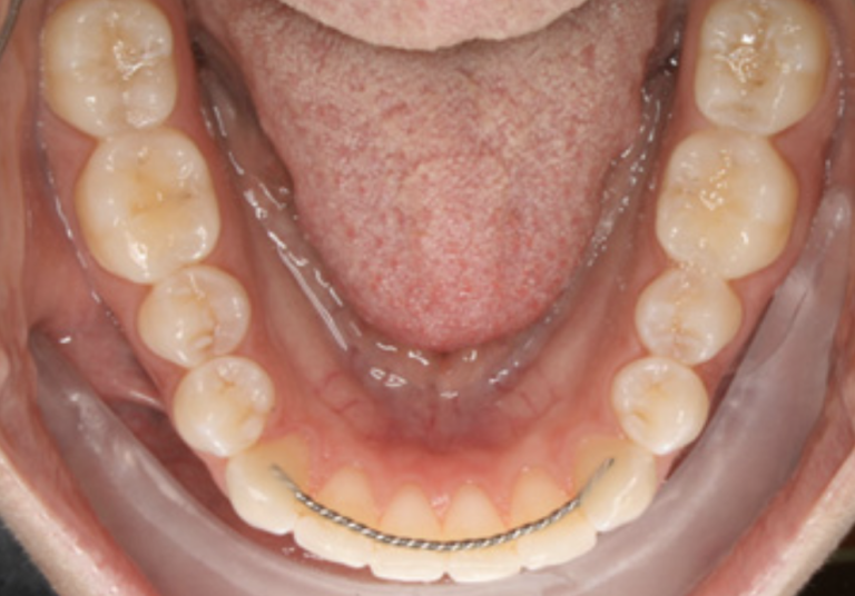 PostOp Instructions Orthodontic Retainers