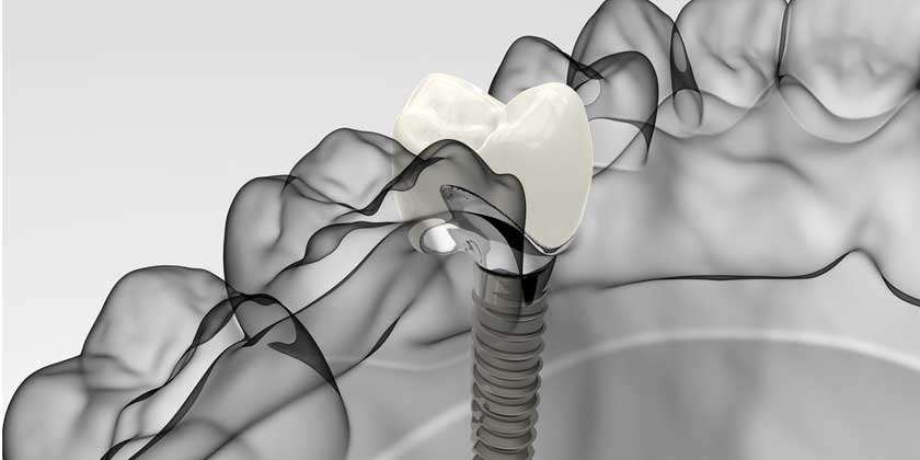 Are dental implants worth it? 15-minute Digital Implant Surgery 101