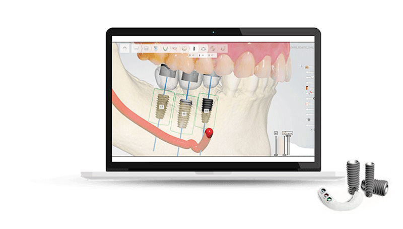 Are dental implants worth it? 15-minute Digital Implant Surgery 101