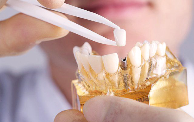 Frequently Asked Questions: Dental Implant or Root Canal, Which Is the Best Option?