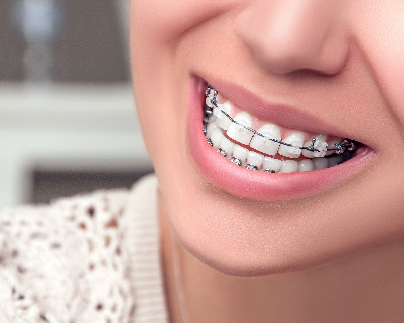 Ceramic-dental Braces-Clear-Braces - Smile Concepts