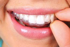 invisalign dental braces