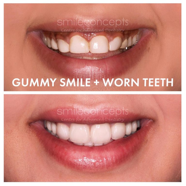 How Much Does A Porcelain Veneer Cost In Australia in 2022?