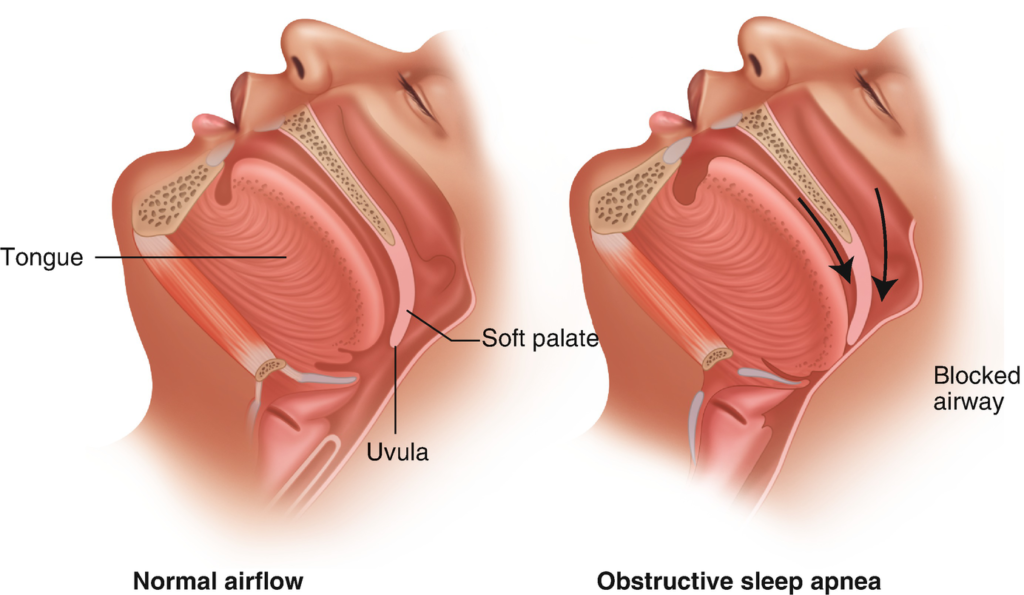 What Is The Main Cause Of Snoring?