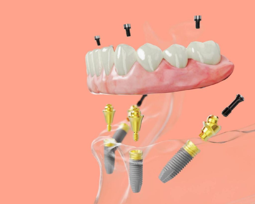 What’s the All-on-4 Dental Implants Cost in Australia?