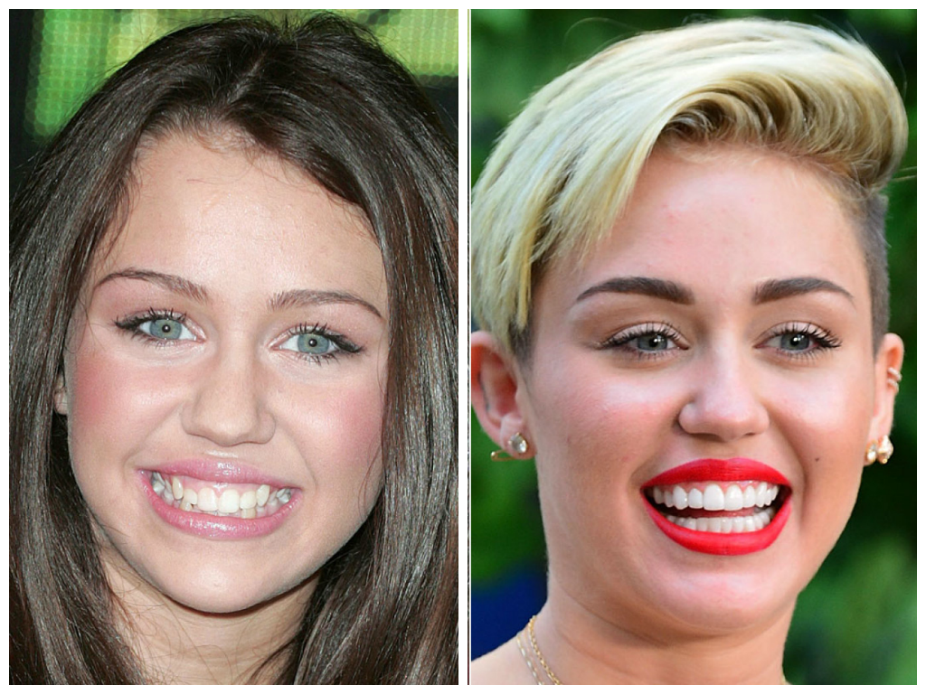 Miley Cyrus veneers before and after