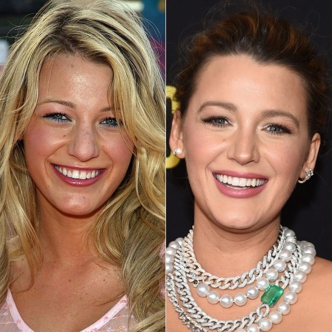 Do All Celebrities Have Veneers? Your Personal Guide on Getting a Hollywood Smile